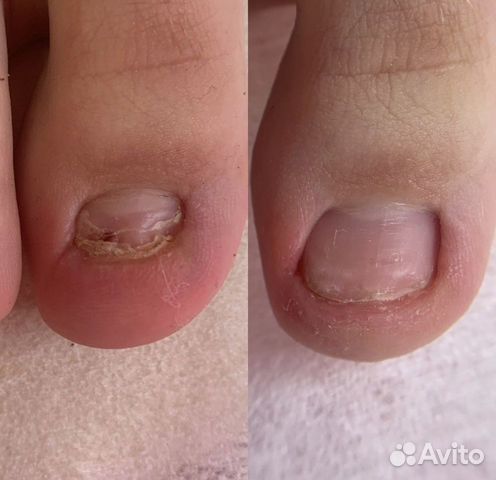 Подолог педикюр