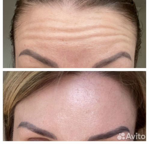 Ботокс для лица