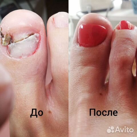 Педикюр любой сложности, вросший ноготь вс,подолог