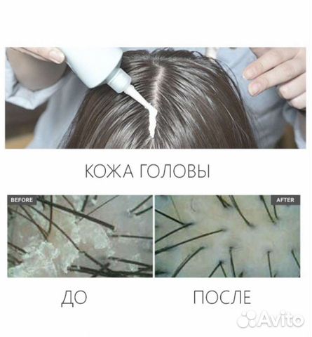 Маска - пилинг для кожи головы от перхоти
